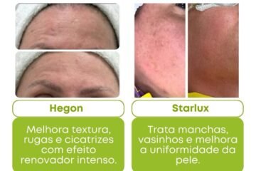 aparelho-hegon-starlux-para-tratamento-facial-santo-andre-clinica-medica-sagita