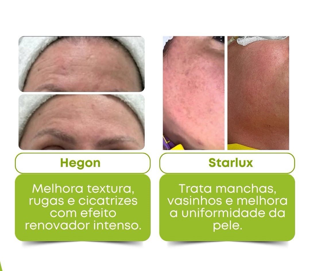 RENOVE SUA PELE: HEGON OU STARLUX? DESCUBRA QUAL TECNOLOGIA É IDEAL PARA O SEU ROSTO