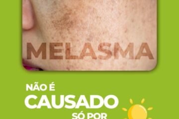 tratamento-para-melasma-santo-andre-abc-paulista-clinica-sagita (1)