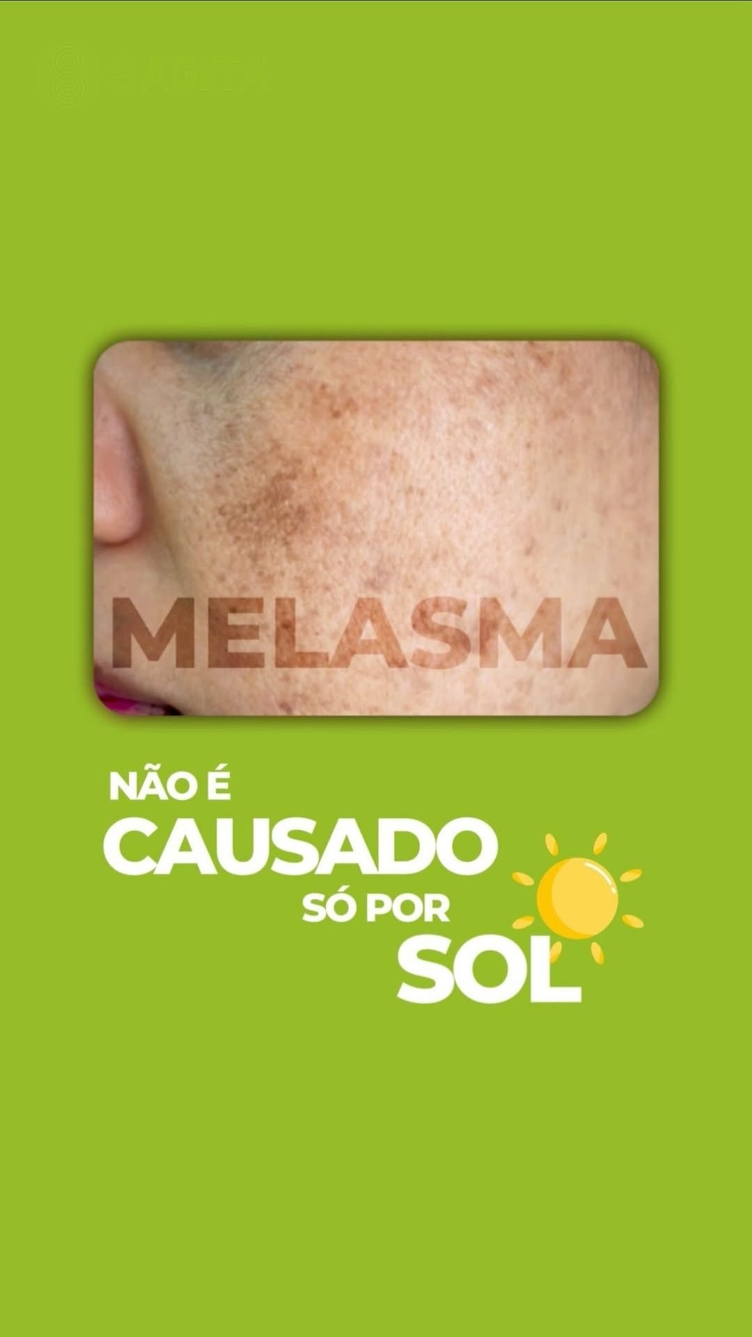 tratamento-para-melasma-santo-andre-abc-paulista-clinica-sagita (1)