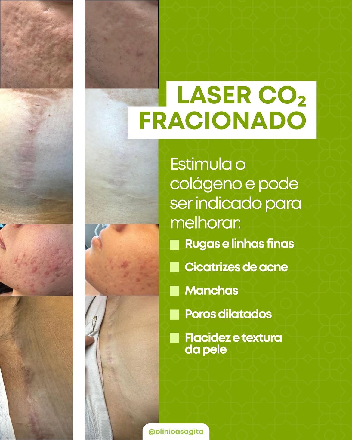 XÔ, RUGUINHAS! COMO O LASER CO₂ AJUDA A RECUPERAR O VIÇO E A FIRMEZA DA PELE